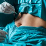 Liposuction for Different Body Types: Personalizing Your Treatment