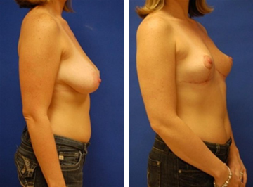 All the Dirty Details of my Breast Reduction Surgery