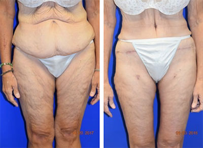 Thigh Lift - Sydney Cosmetic Clinic